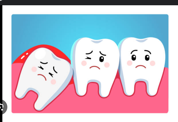 Wisdom teeth removal